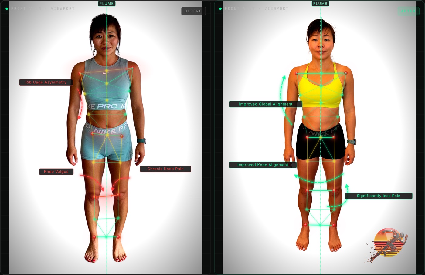 Coco D. front view posture before and after