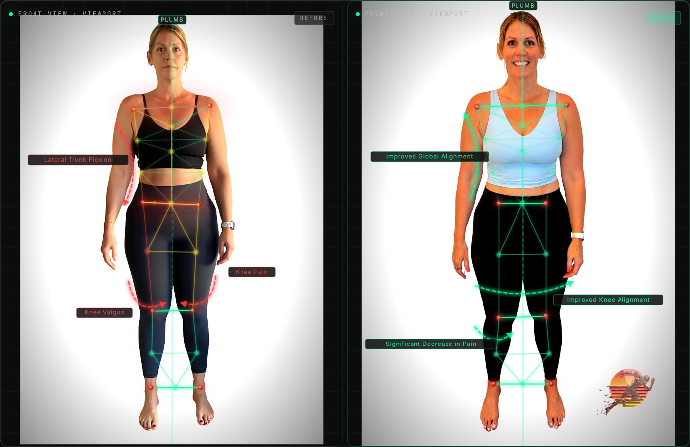 Kelly F. front view posture before and after
